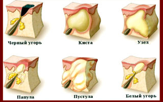 Разновидности прыщей